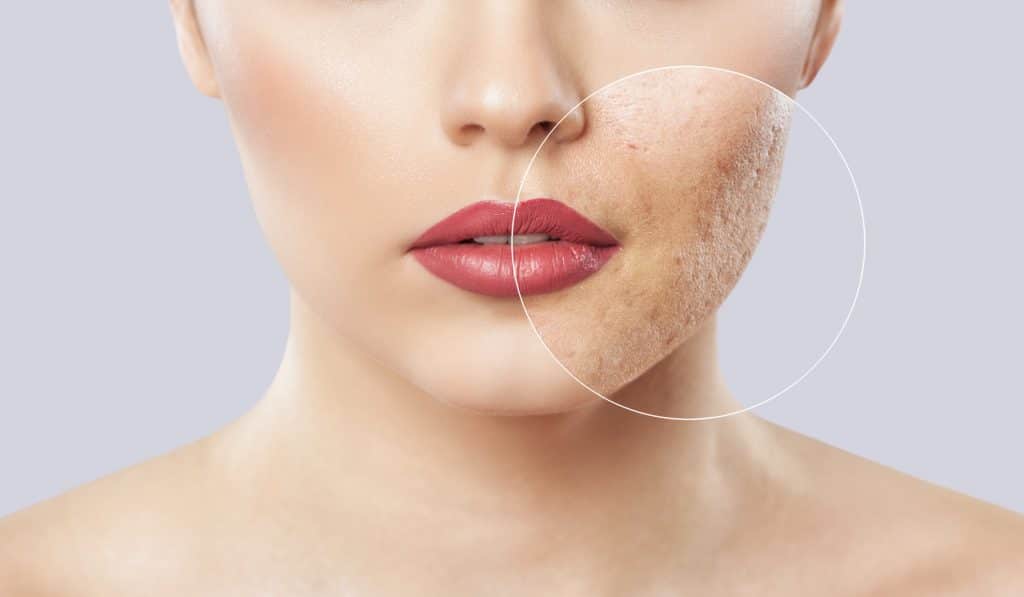 femme ayant des cicatrice d'acnes et pores dilate de face