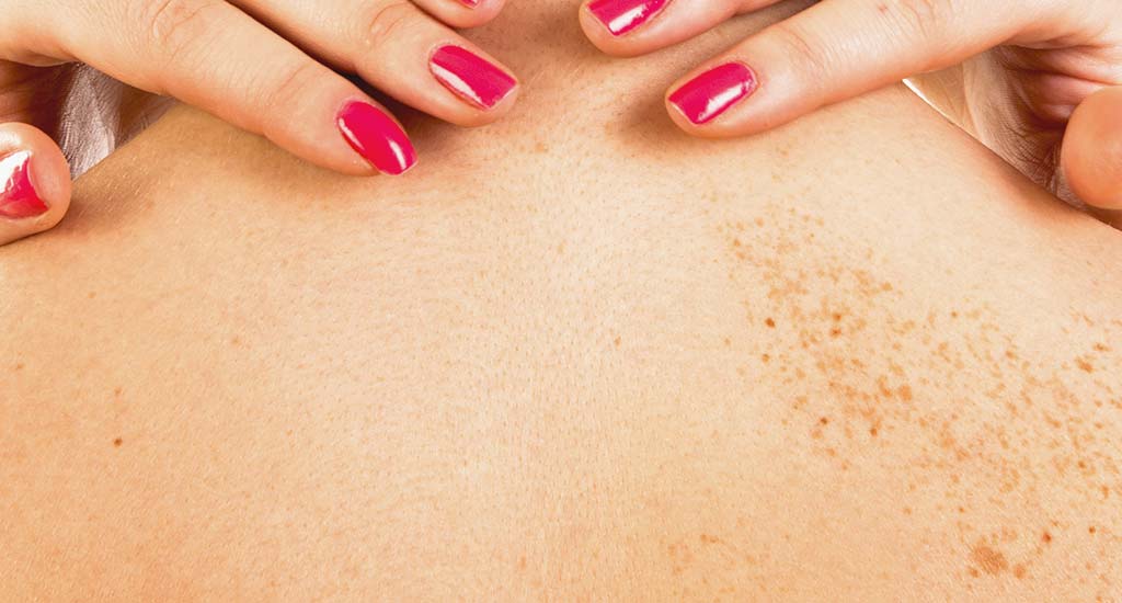 Comment enlever les tâches de soleil ? - My Laser