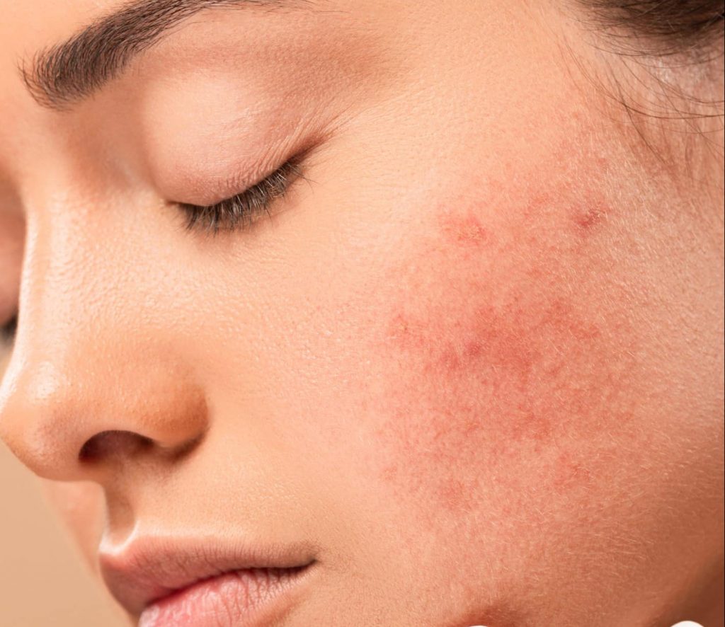 Comment atténuez la couperose du visage ? - My Laser