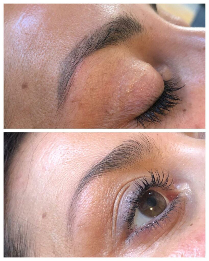 femme ayant effectué un détatouage sourcil avant après