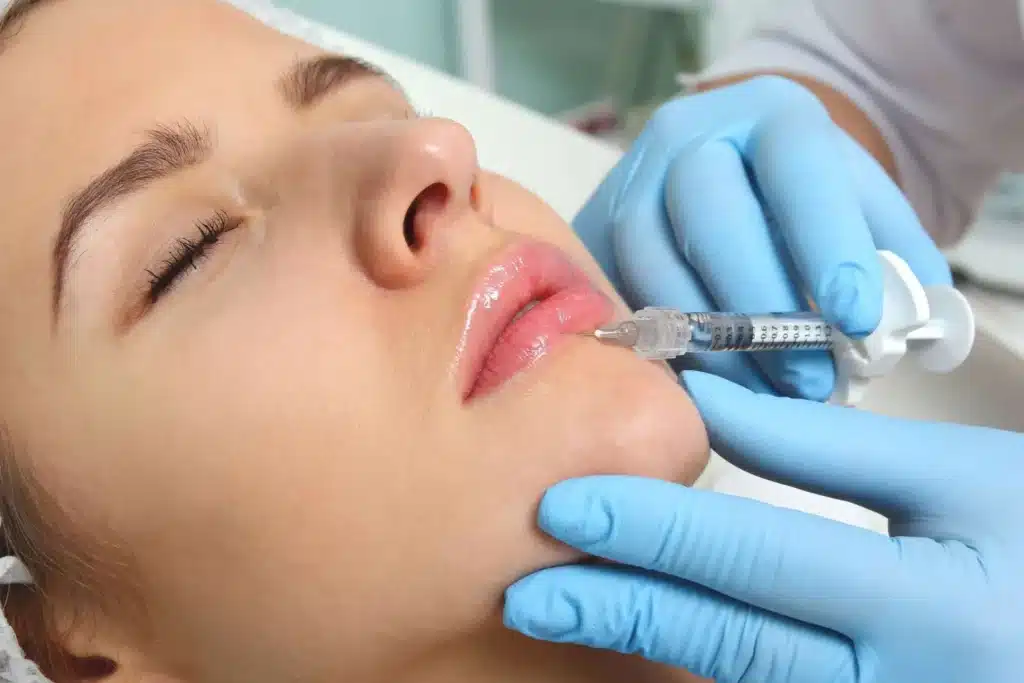 Injection dans les lèvres d'acide hyaluronique Injection dans les lèvres d'acide hyaluronique