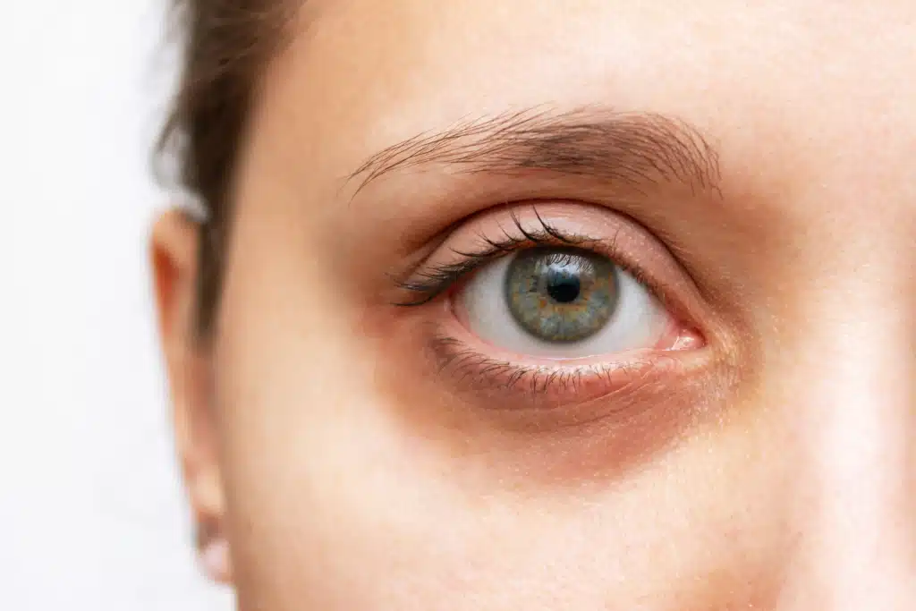 Comment Enlever les Cernes Sous les Yeux ? Comment Enlever les Cernes Sous les Yeux ?