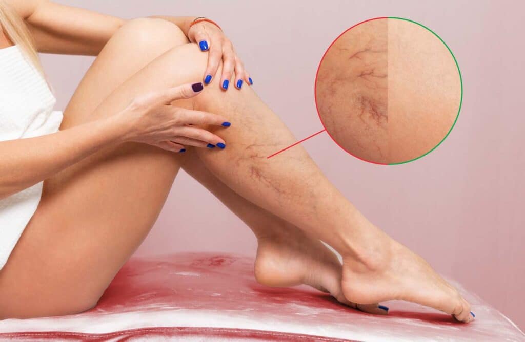 varicosite femme jambes plié