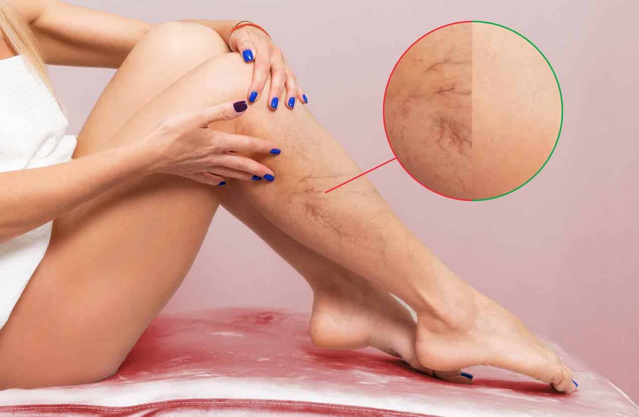 varicosite femme jambes plié