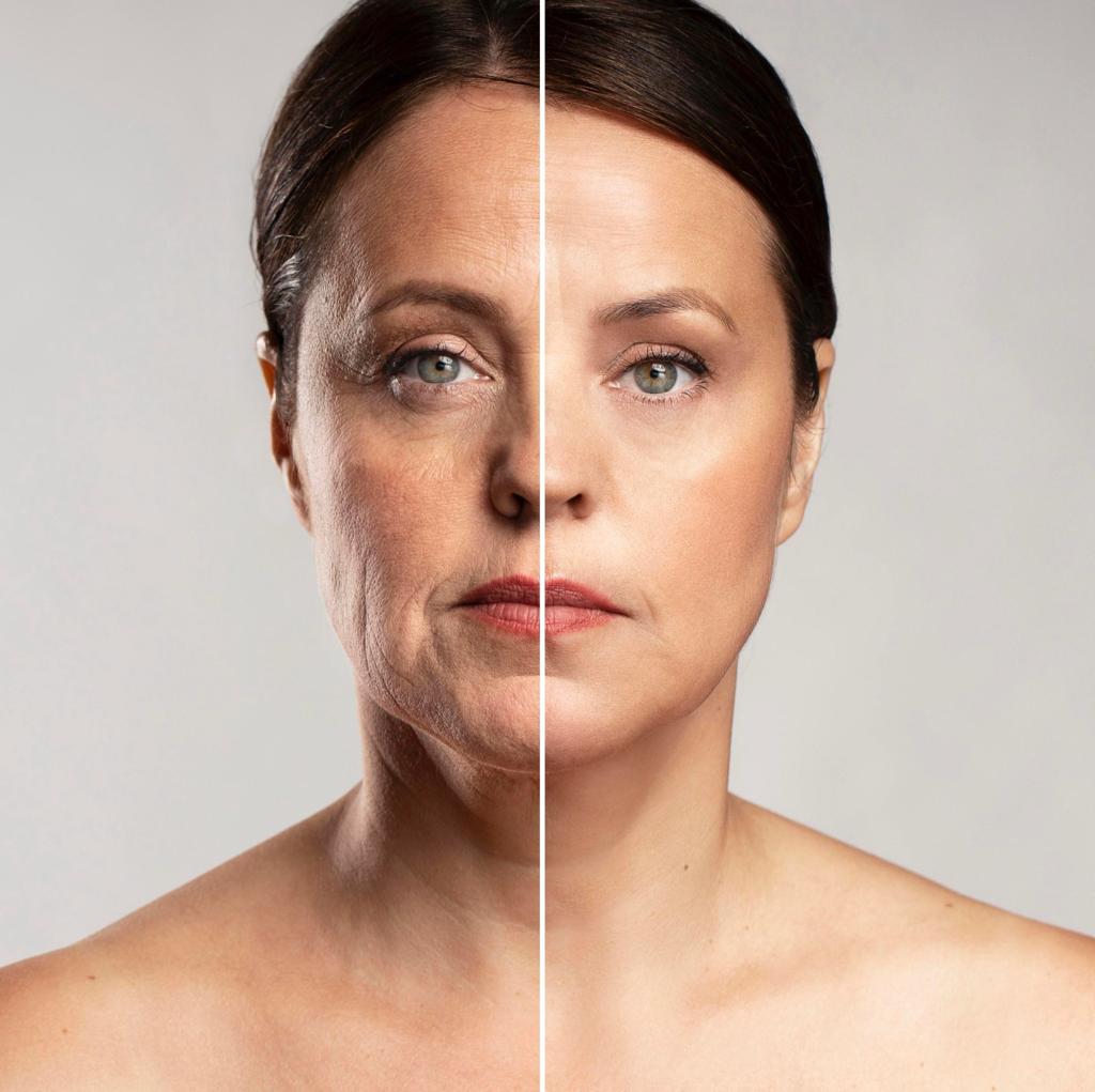 endolift lifting