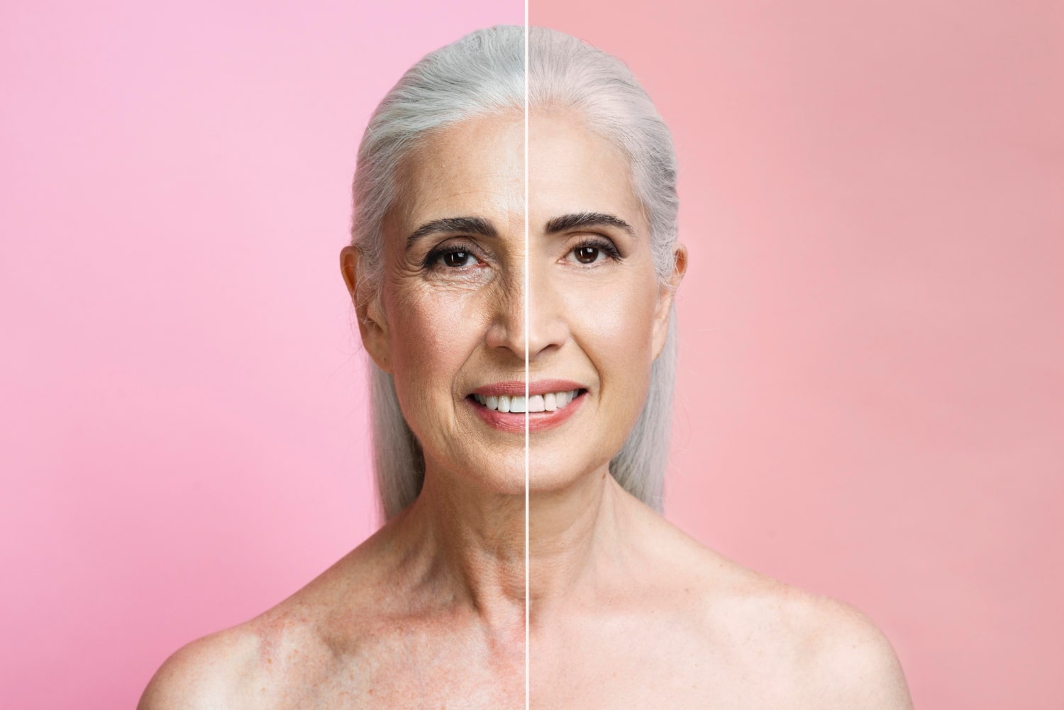 endolift avant après