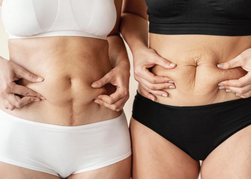 Cryolipolyse : Éliminez vos amas graisseux sans chirurgie !