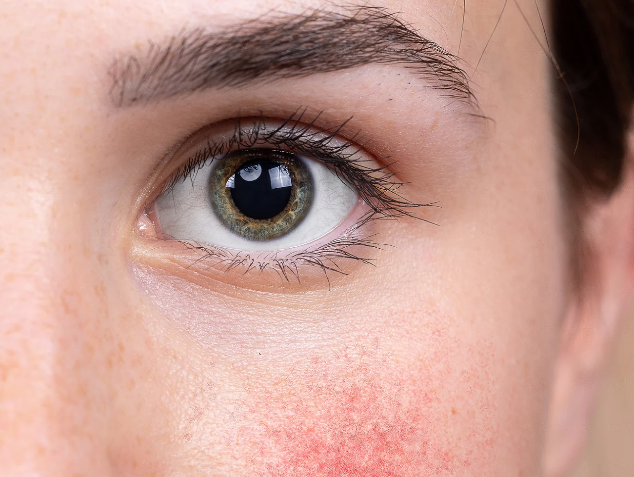 Symptômes de la varicosité du visage : Les premiers signes