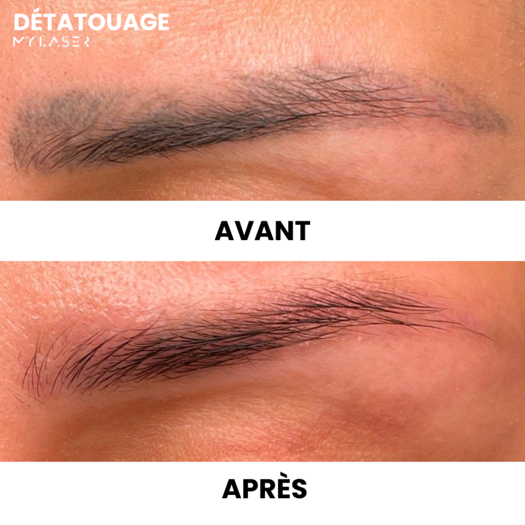 avant/après détatouage sourcil