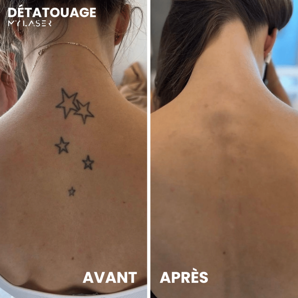 détatouage dos - My Laser