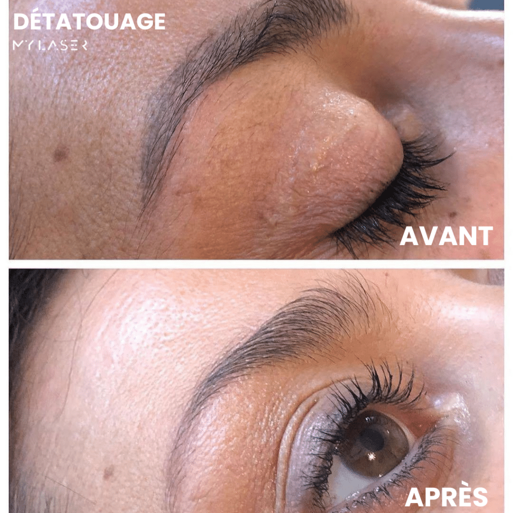 Détatouage sourcils My Laser