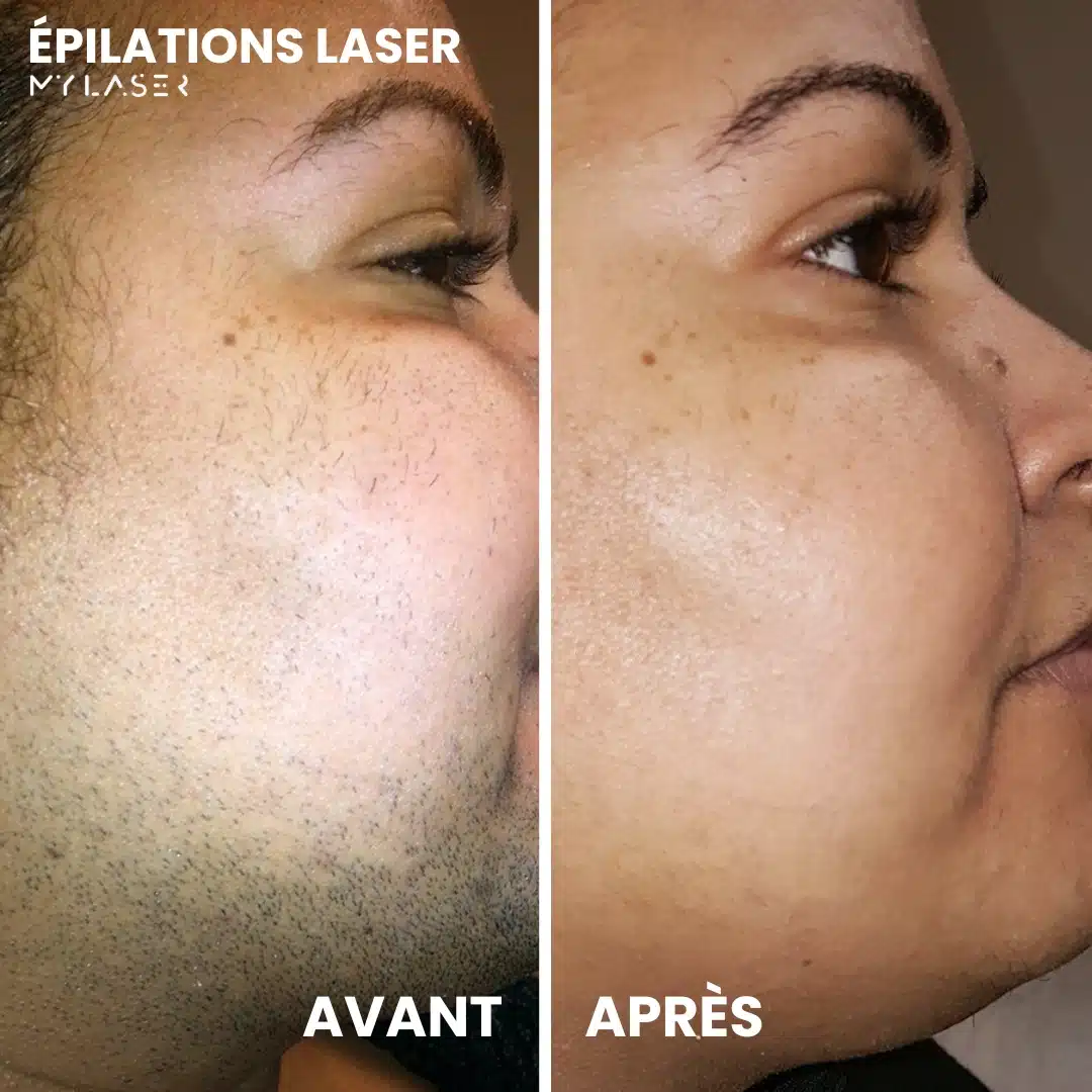 Épilation laser visage femme - Résultat sur duvet et poils