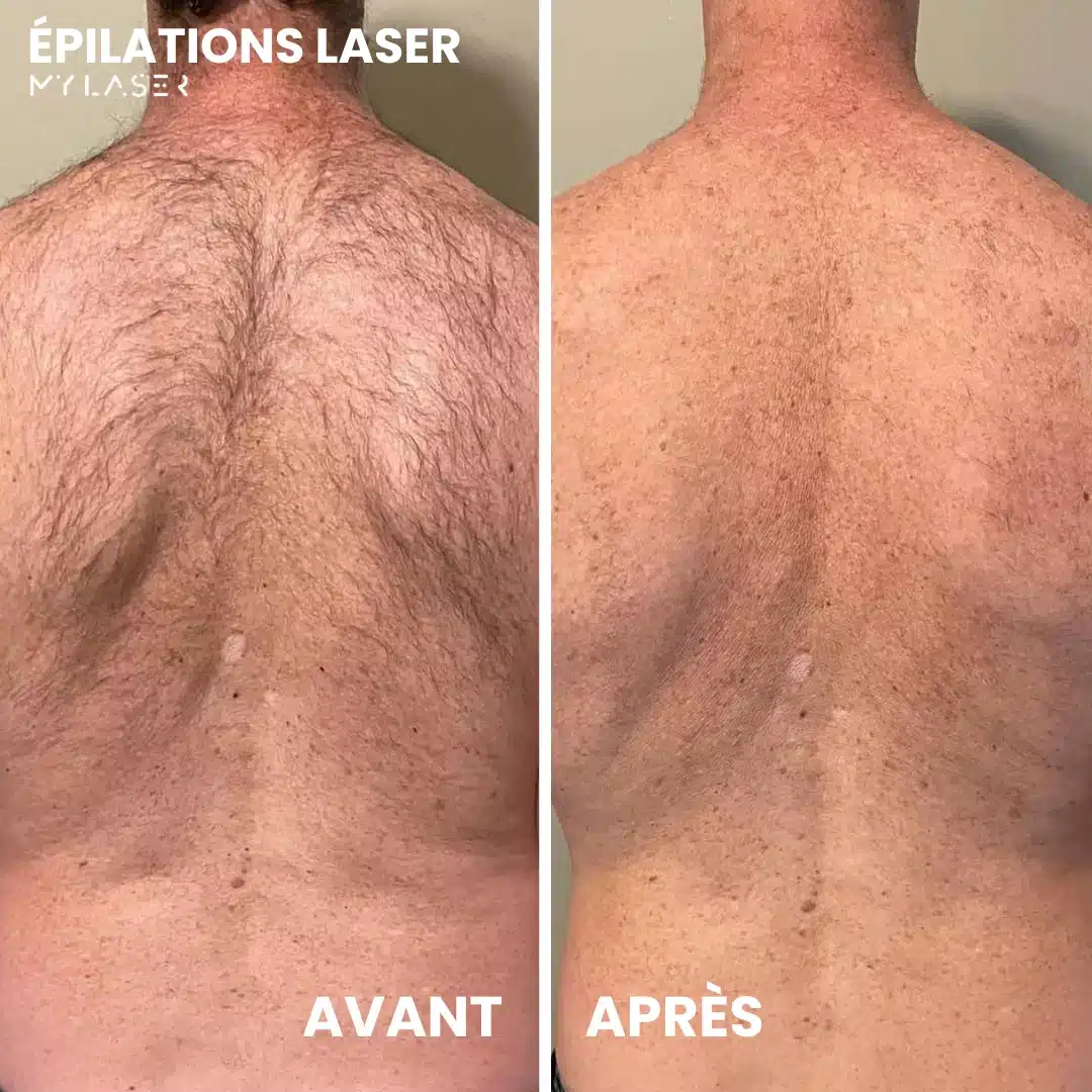 Épilation laser dos homme - Avant-après traitement complet