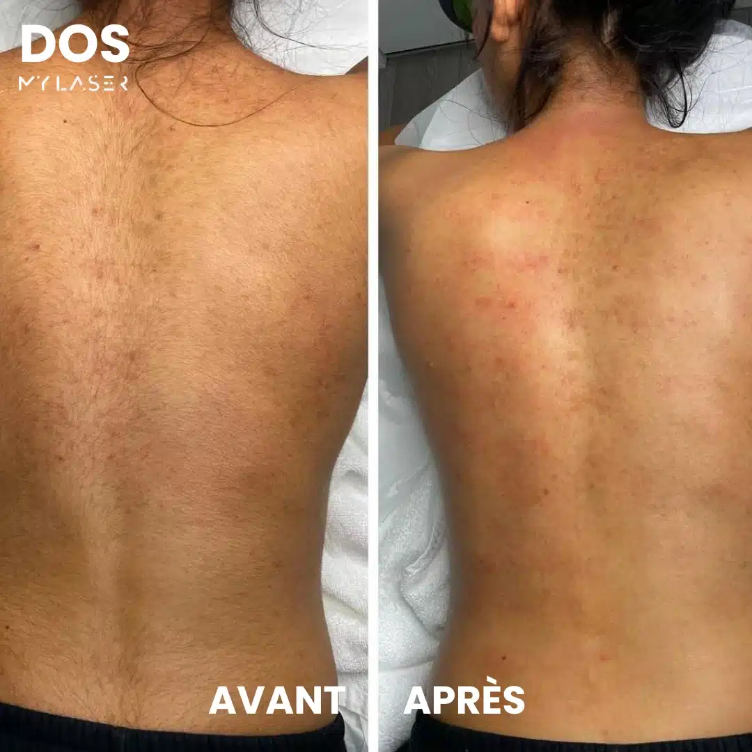 Épilation laser du dos femme - Résultat avant-après sur peau claire