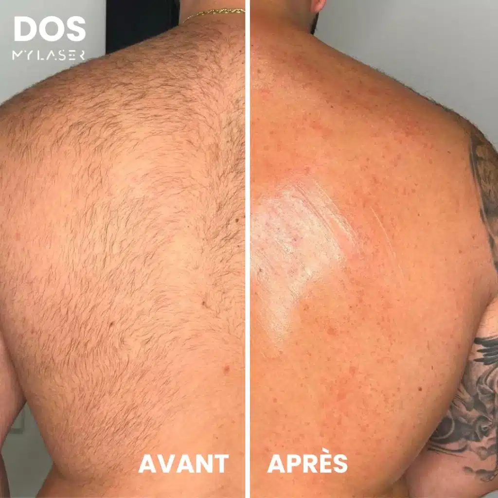 Traitement épilation laser dos - Transformation épaule et omoplate