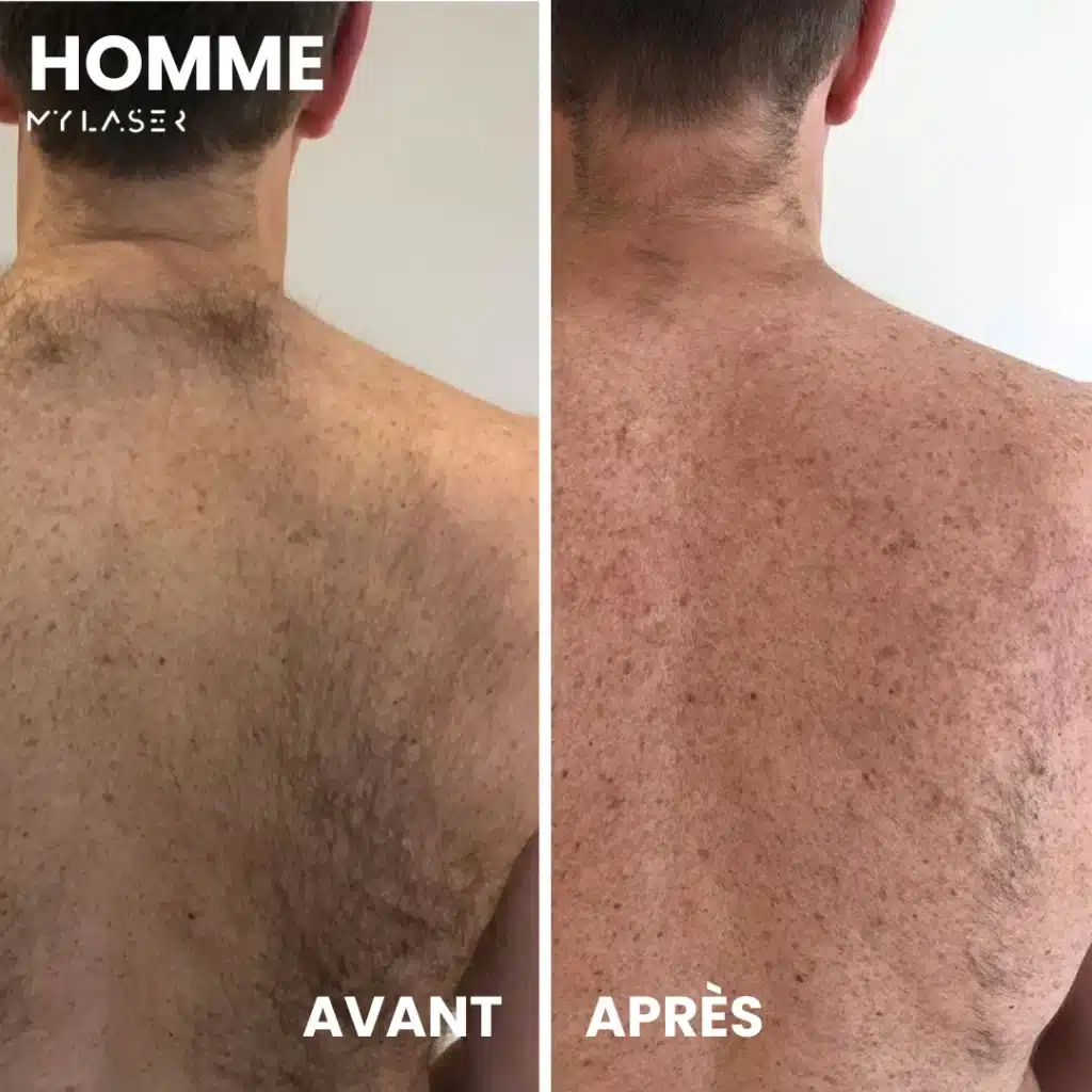 Épilation laser du dos homme - Transformation avant-après