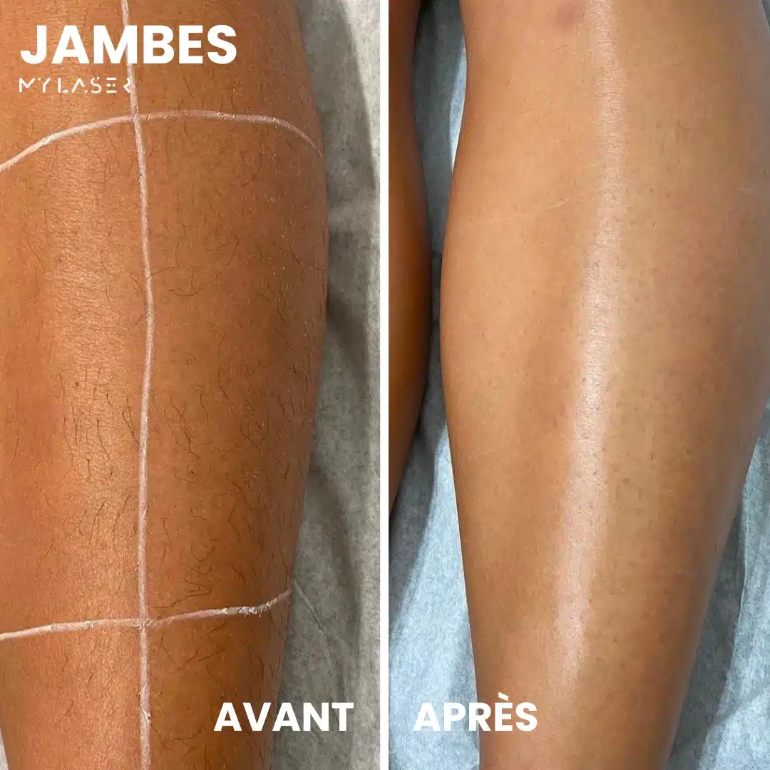 Épilation laser zone tibiale - Résultats visibles avant/après