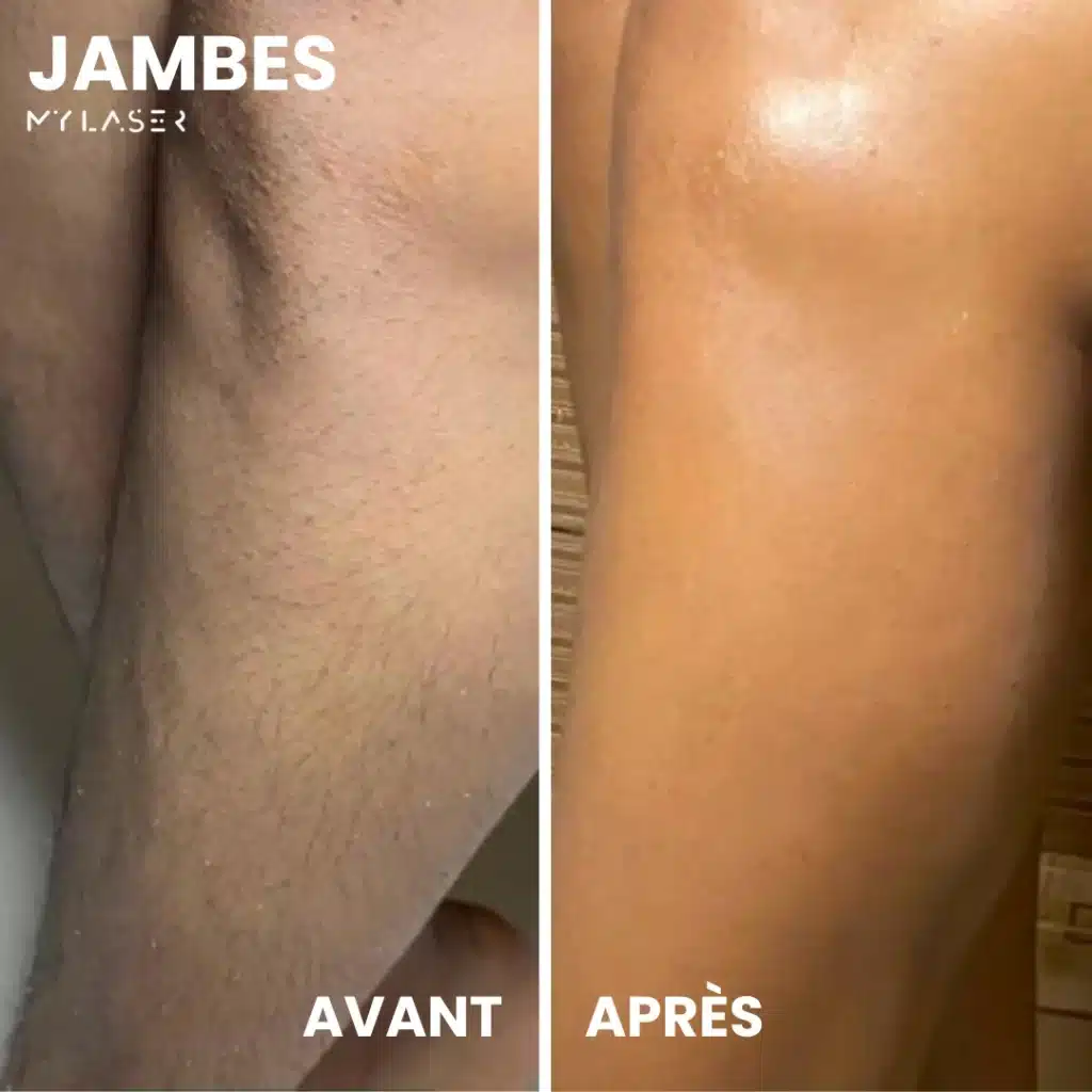 Effet épilation laser sur poils jambes - Résultat après séances