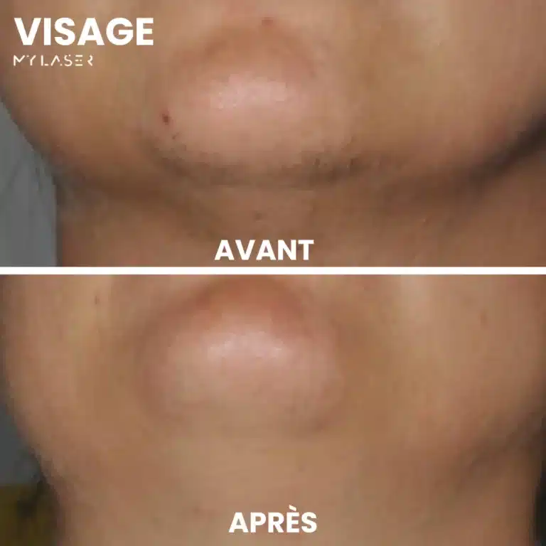 Épilation définitive laser menton : comparaison avant-après traitement