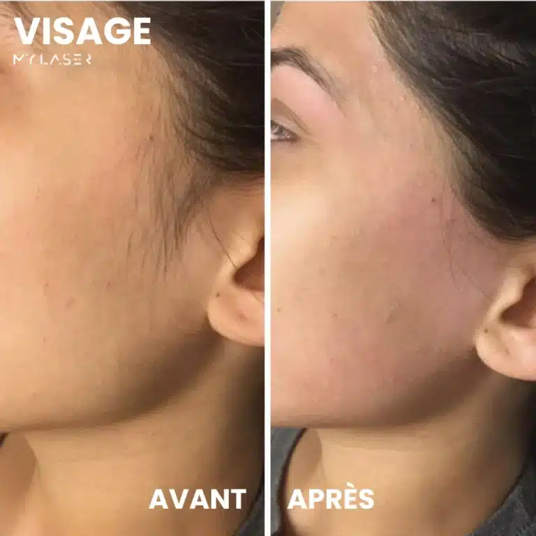 Épilation laser femme visage : résultat avant-après duvet joues