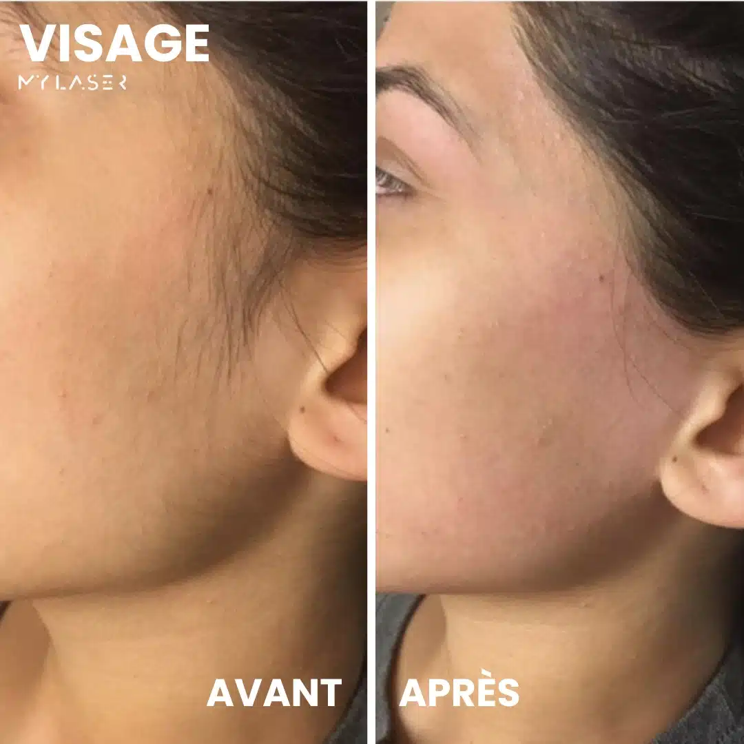 Épilation laser femme visage : résultat avant-après duvet joues