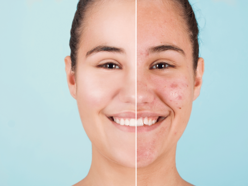 Le Laser Fractionné pour la réjuvénation de la peau : Quels Avantages ?