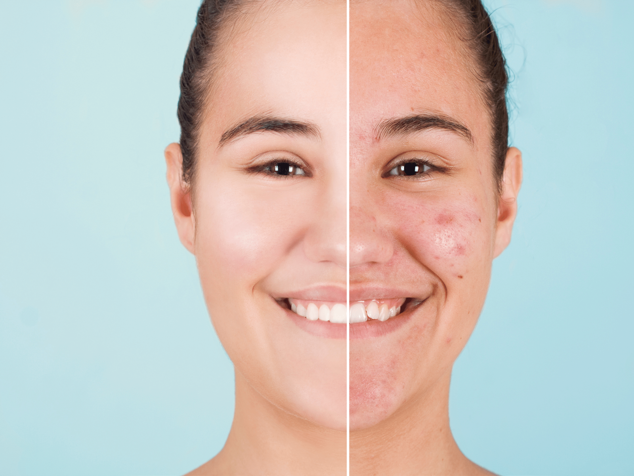Le Laser Fractionné pour la réjuvénation de la peau : Quels Avantages ?