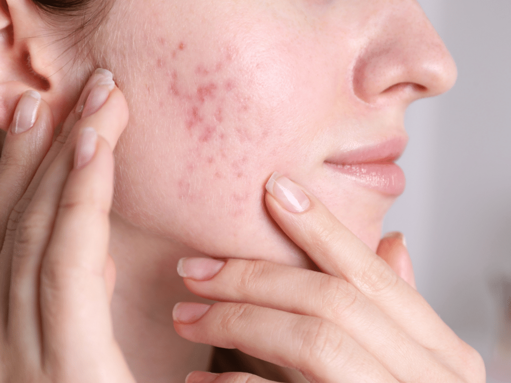 Le Laser Fractionné pour la réjuvénation de la peau : Quels Avantages ?