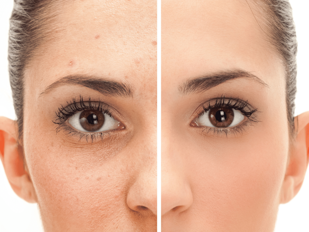 Les Poches Sous les Yeux : Guide Expert Solution Esthétique - My Laser