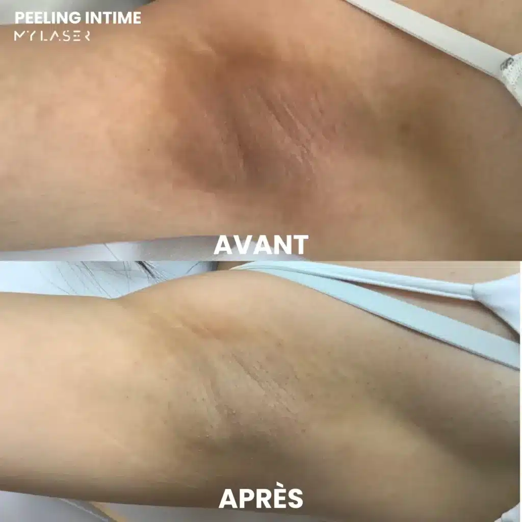 Soin Peeling Intime | Prenez soin de vous | My Laser