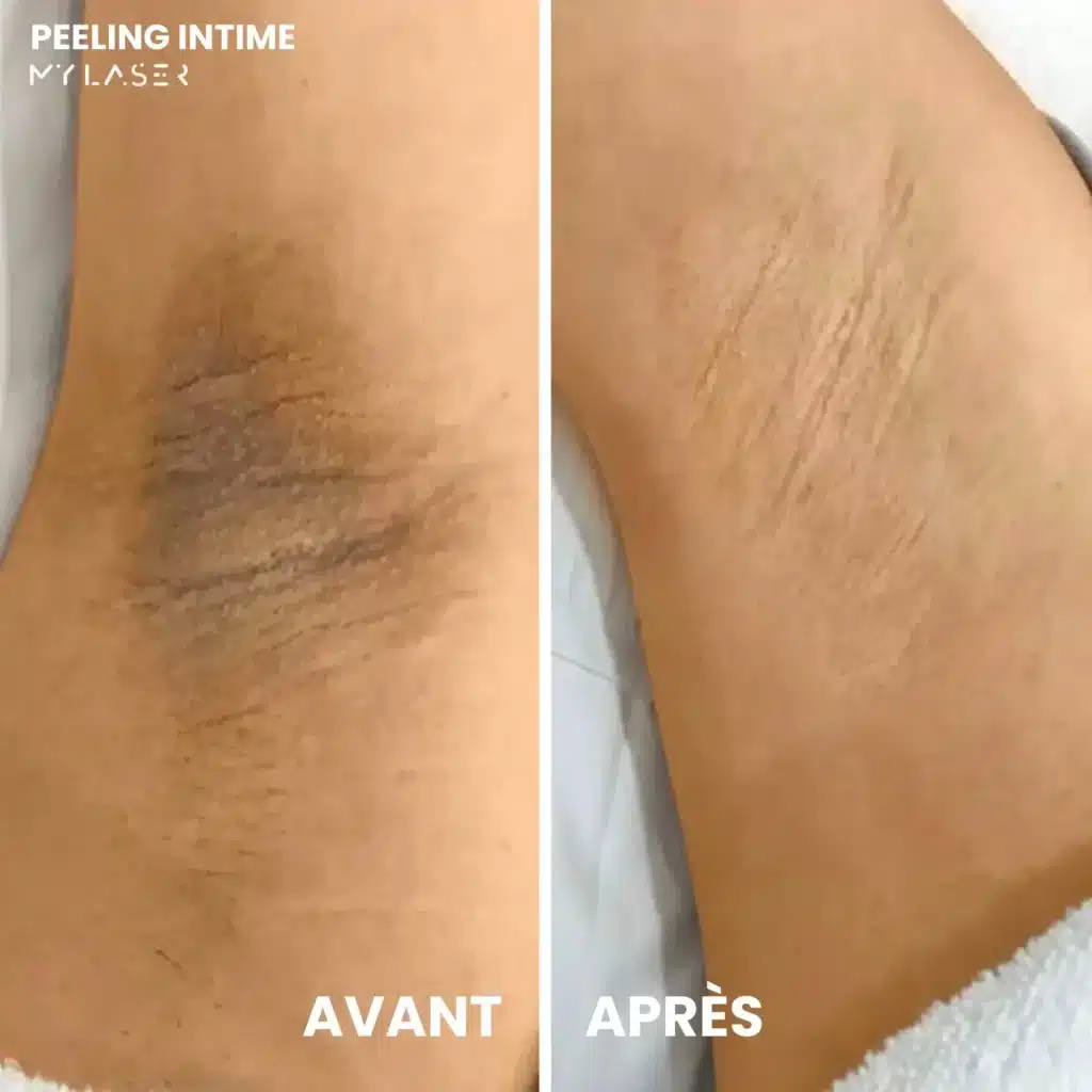 Soin Peeling Intime | Prenez soin de vous | My Laser