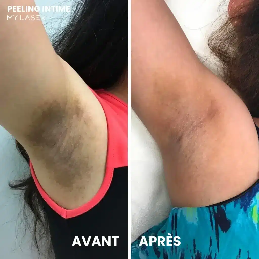 Soin Peeling Intime | Prenez soin de vous | My Laser