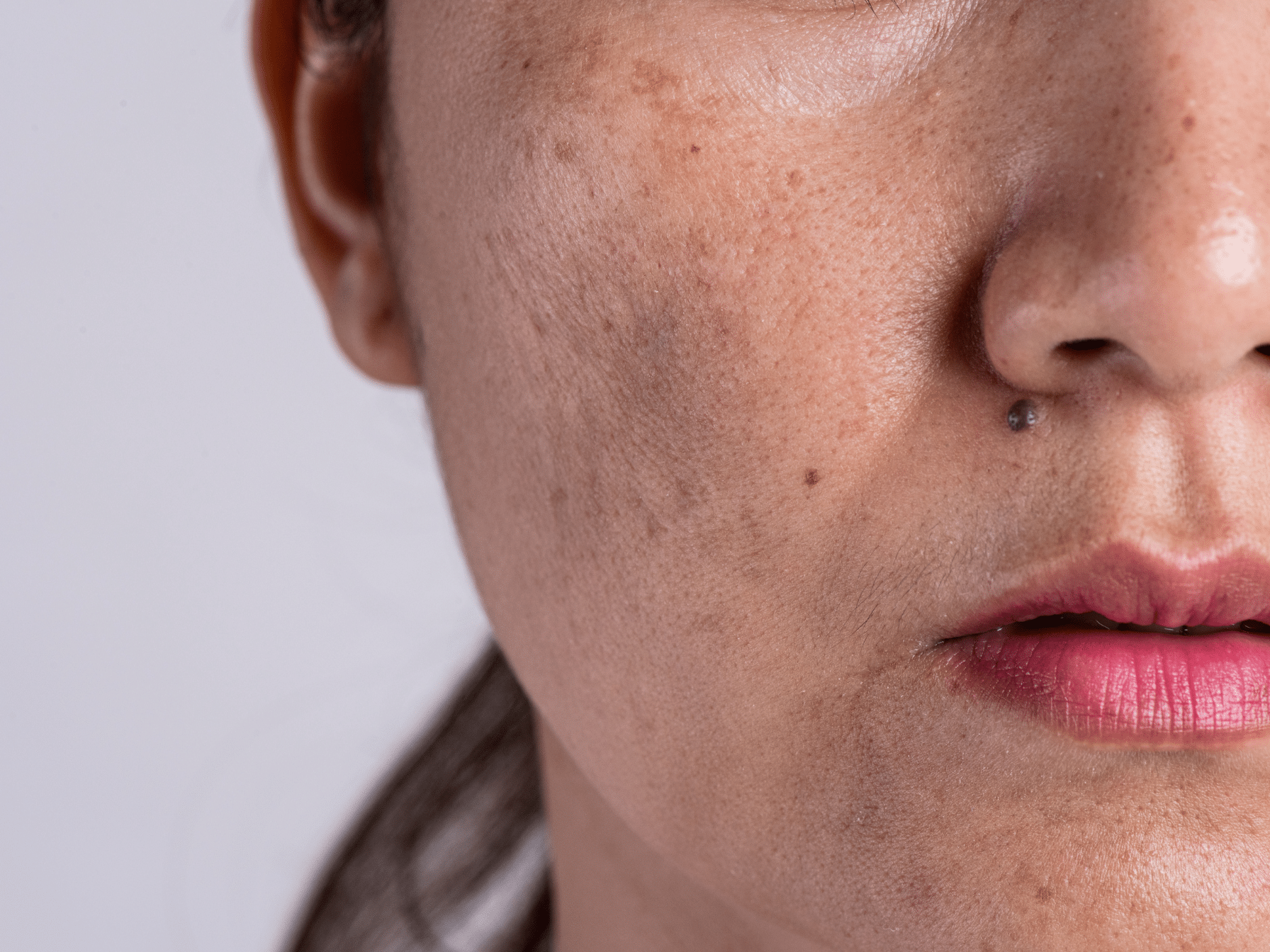 Mélasma ou Tâches Solaires ? Guide Expert Pour Ne Plus Confondre - My Laser