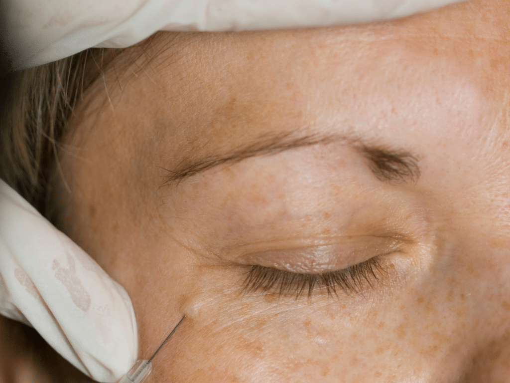 Plus De Cernes Avec L'Acide Hyaluronique : Secrets Des Experts Médical - My Laser