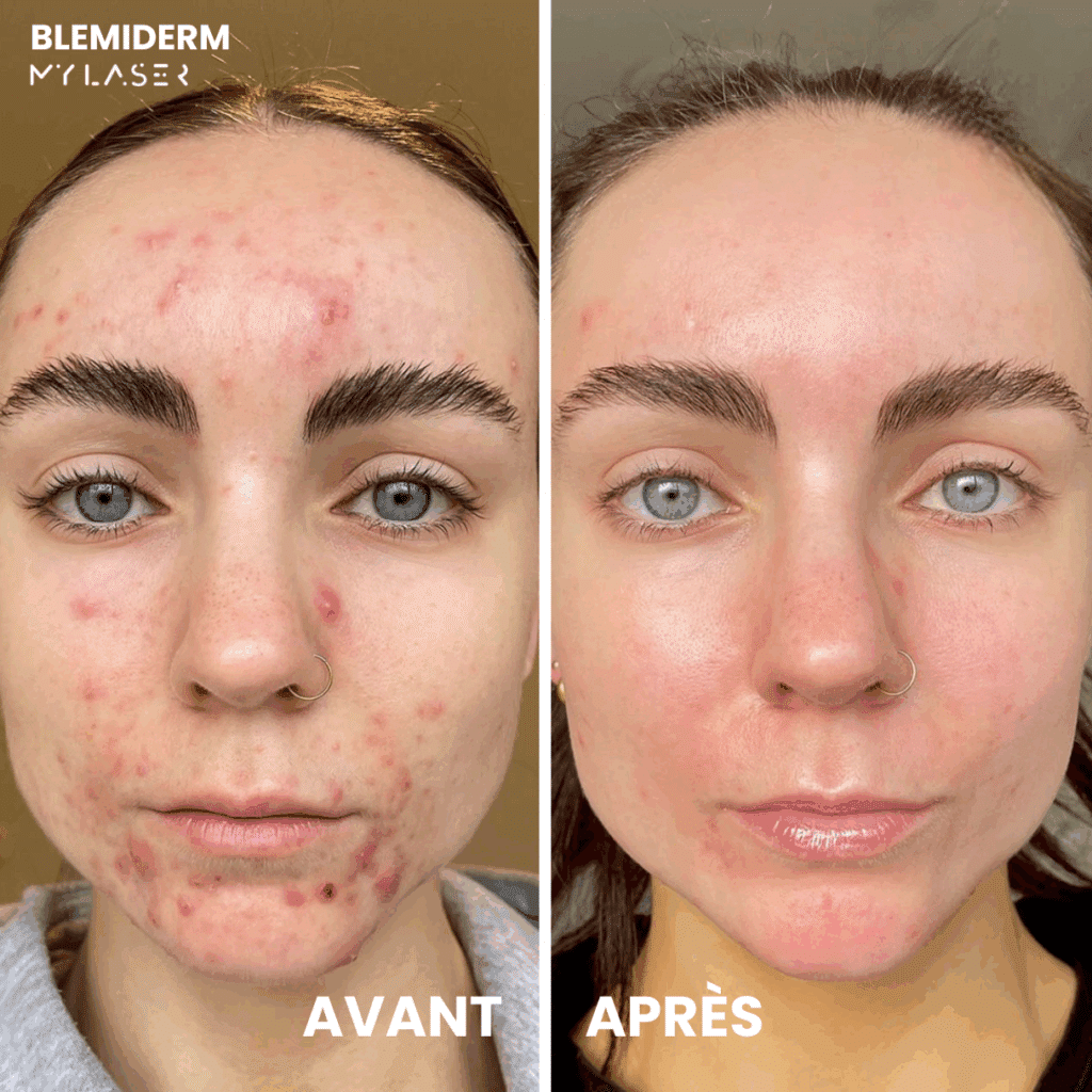 Protocole My Laser x Blemiderm - My Laser