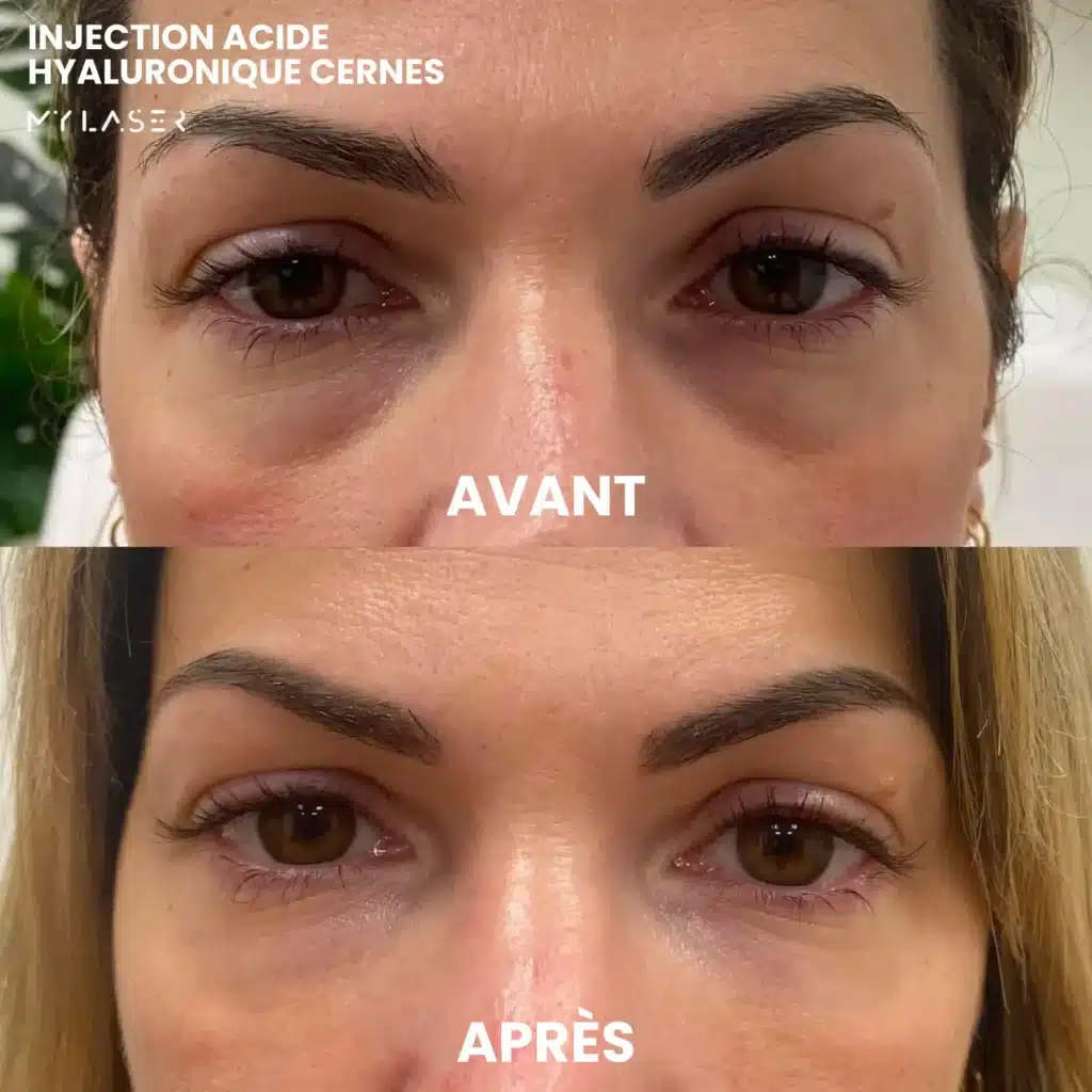 Injection Acide Hyaluronique | Infos et tarifs