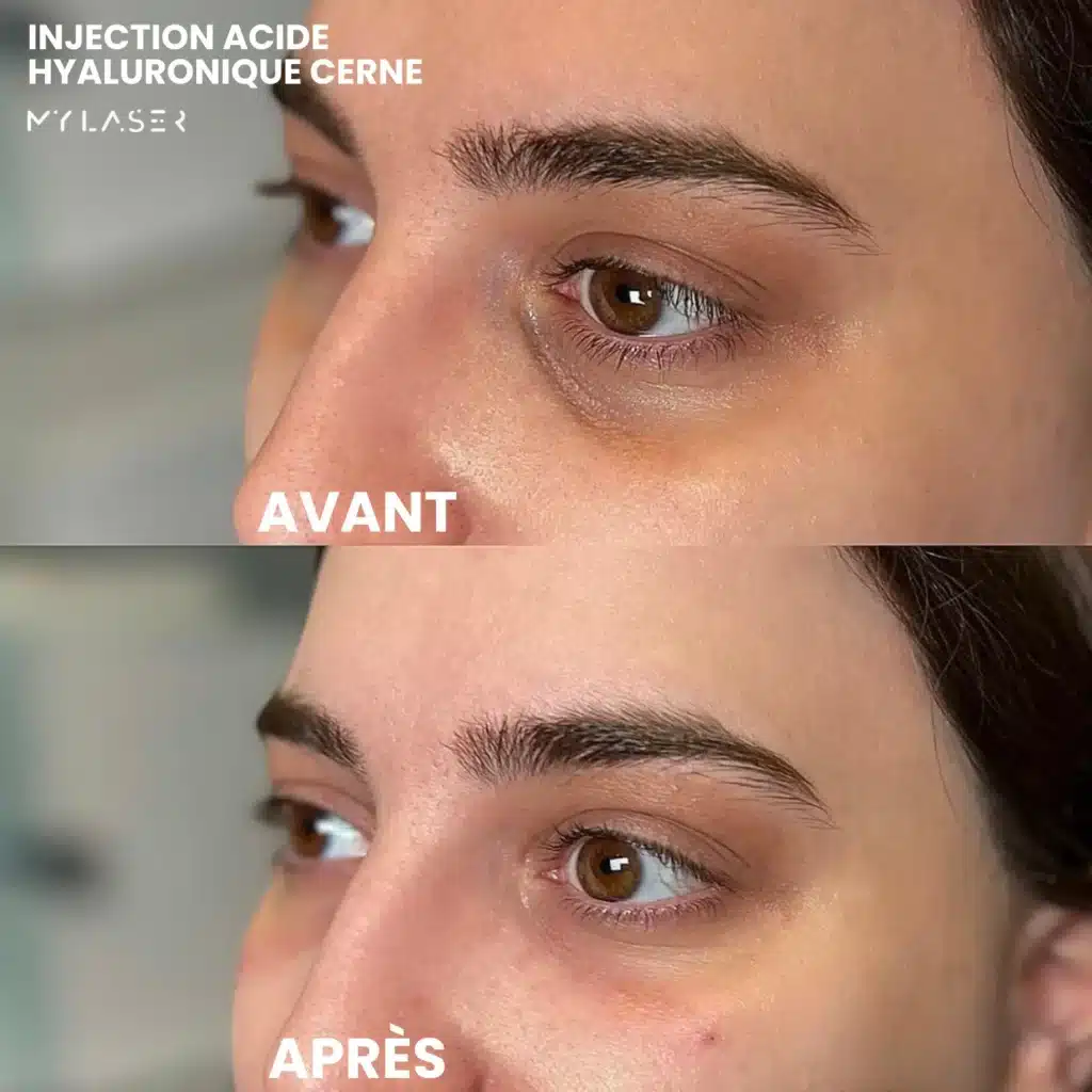 Injection Acide Hyaluronique | Infos et tarifs