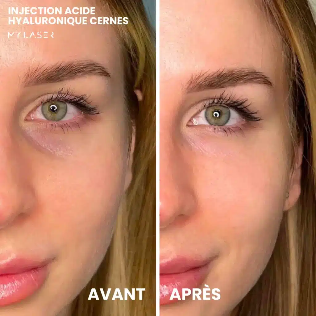 Injection Acide Hyaluronique | Infos et tarifs