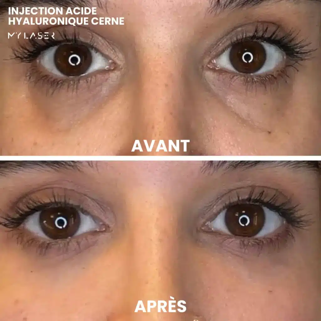 Injection Acide Hyaluronique | Infos et tarifs