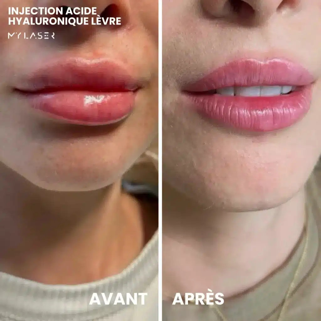 Injection Acide Hyaluronique | Infos et tarifs