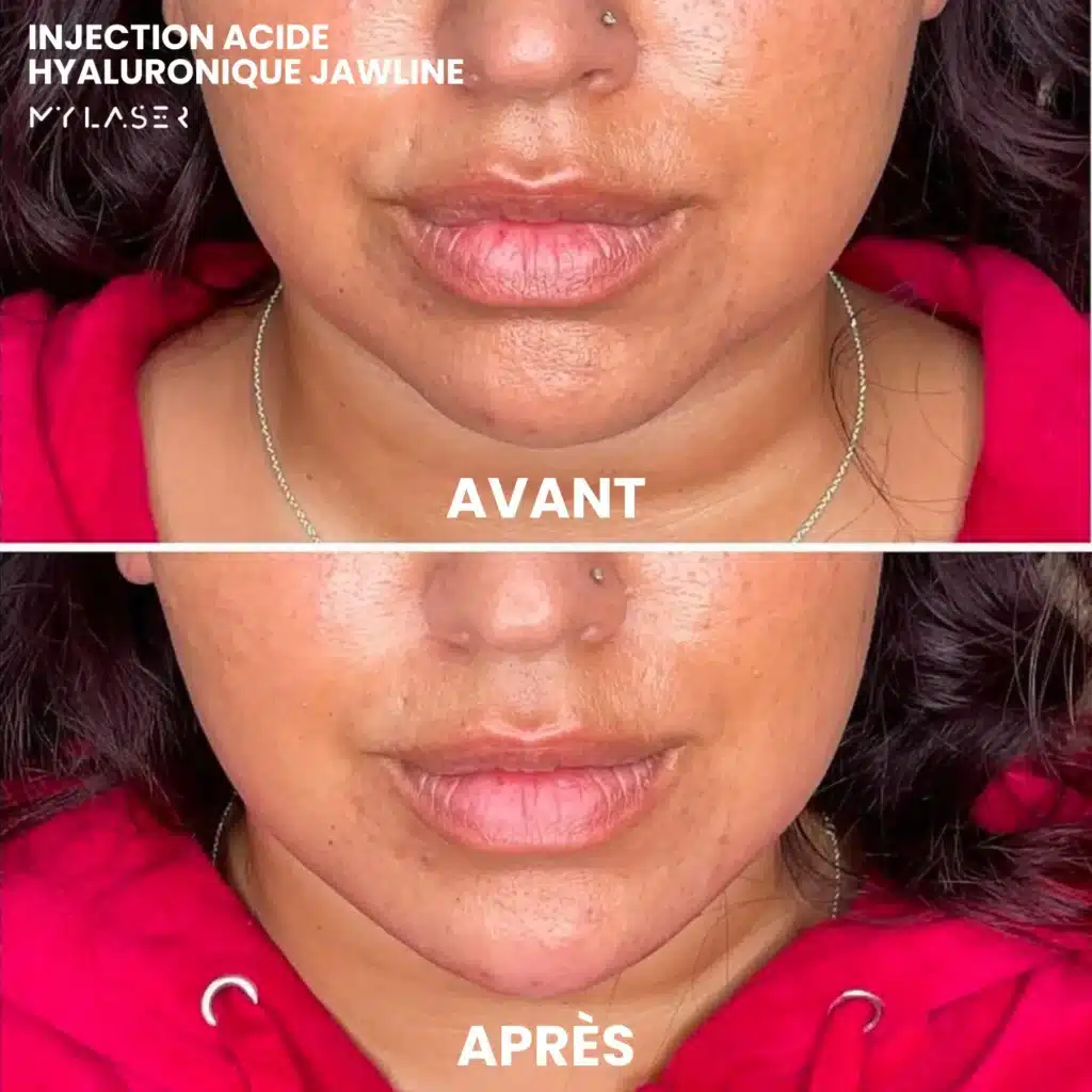 Injection Acide Hyaluronique | Infos et tarifs