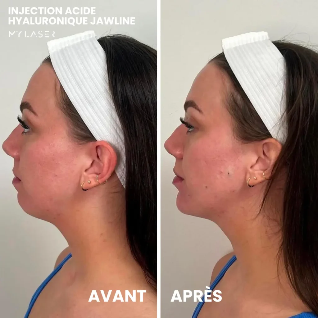 Injection Acide Hyaluronique | Infos et tarifs