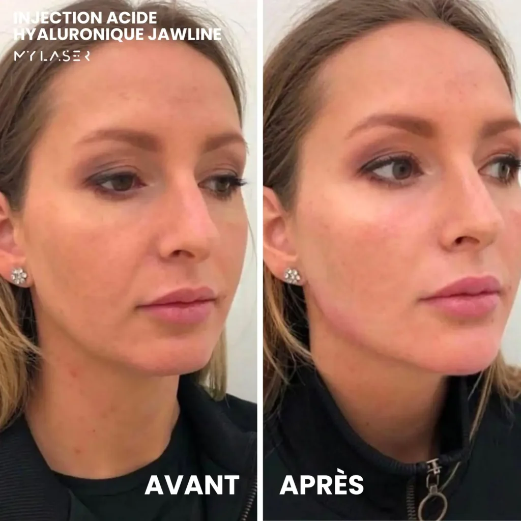 Injection Acide Hyaluronique | Infos et tarifs