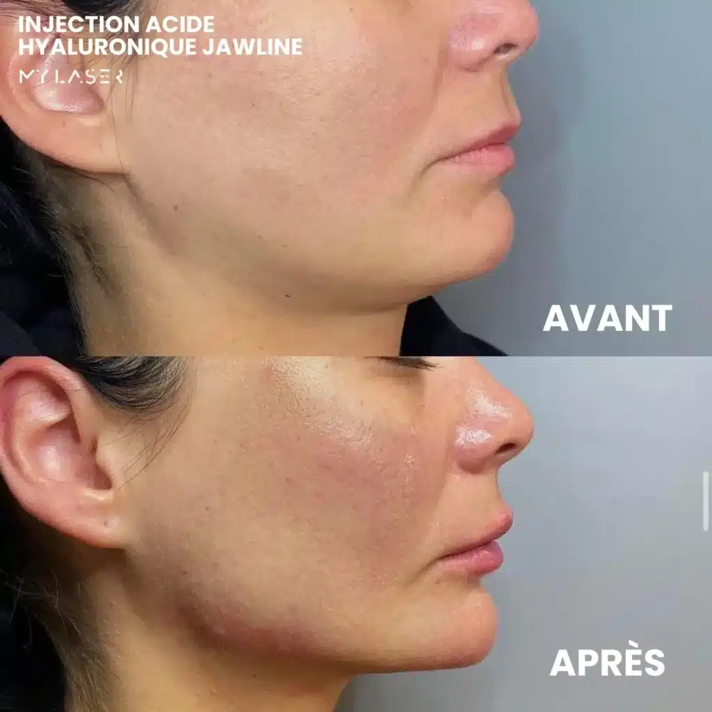 Injection Acide Hyaluronique | Infos et tarifs