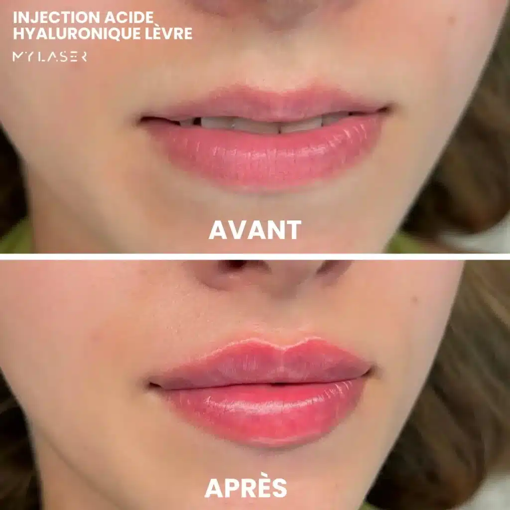 Injection Acide Hyaluronique | Infos et tarifs
