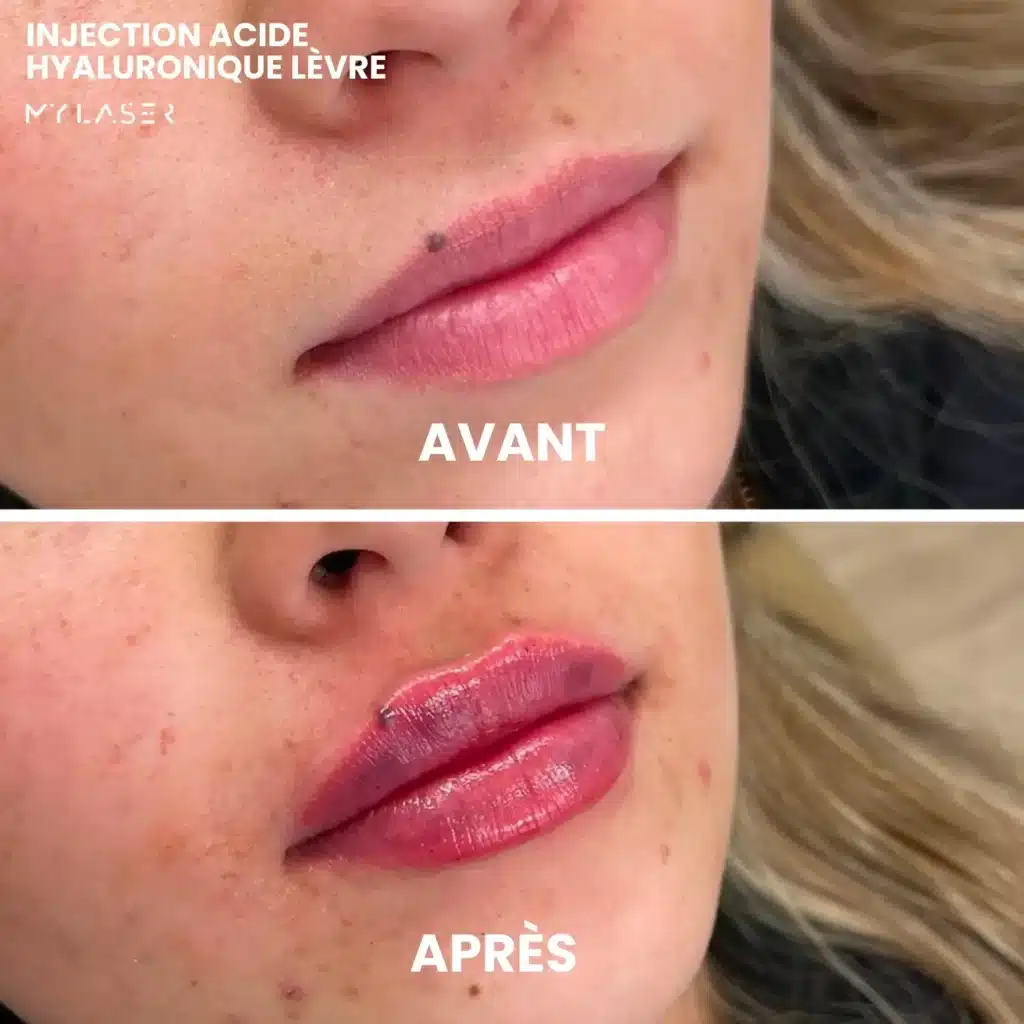 Injection Acide Hyaluronique | Infos et tarifs