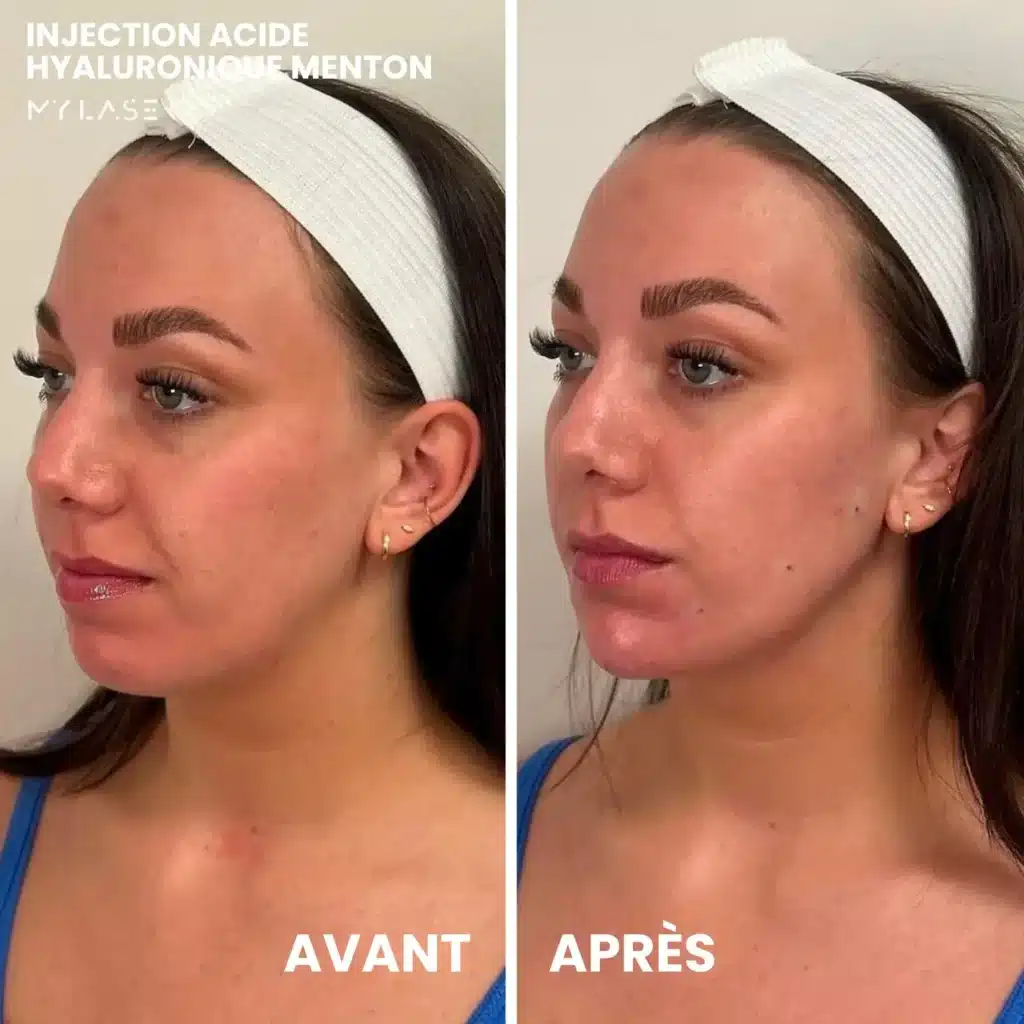 Injection Acide Hyaluronique | Infos et tarifs