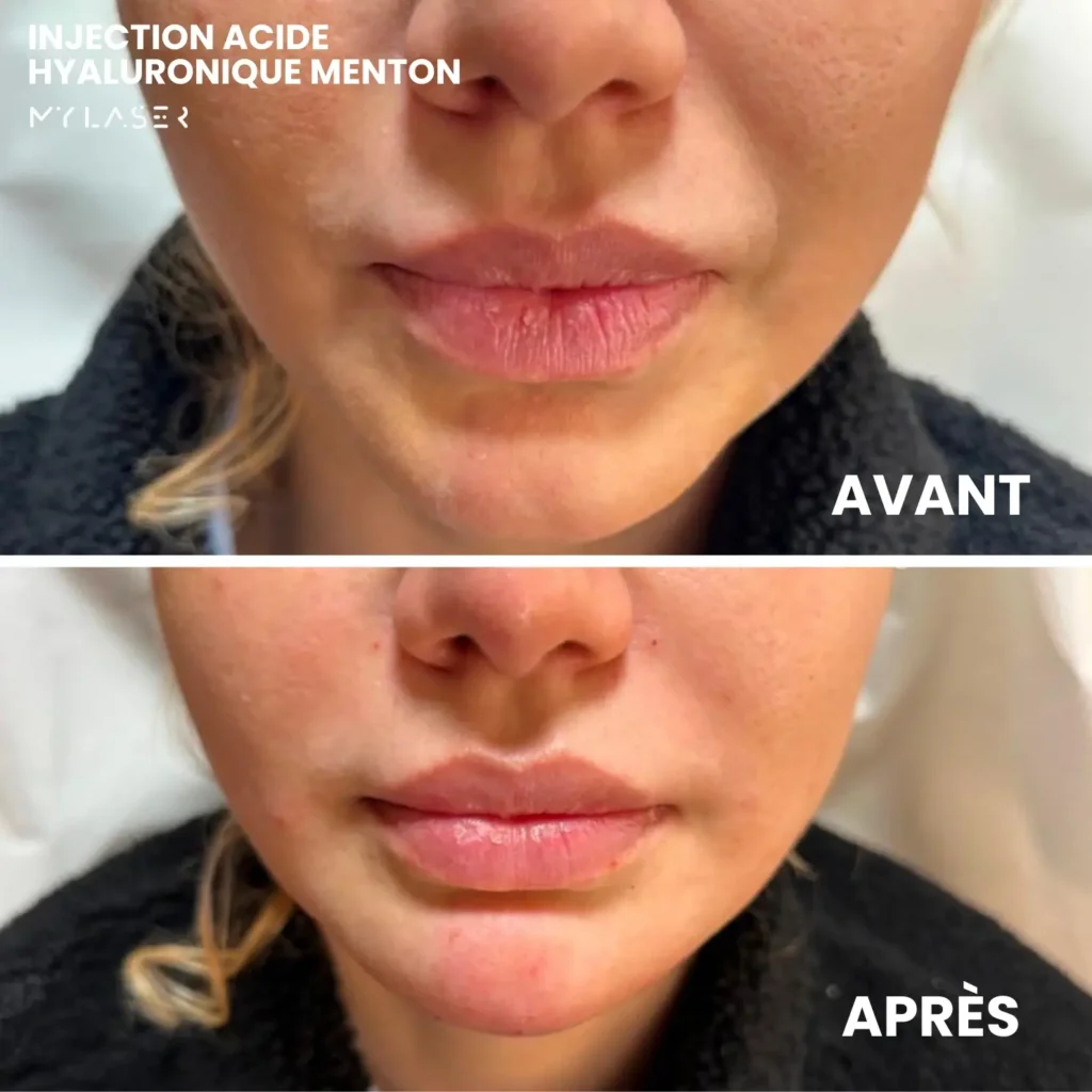 Injection Acide Hyaluronique | Infos et tarifs