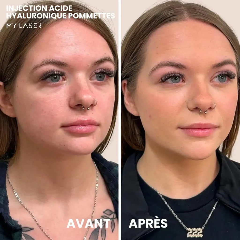 Injection Acide Hyaluronique | Infos et tarifs