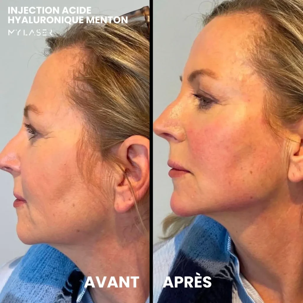 Injection Acide Hyaluronique | Infos et tarifs